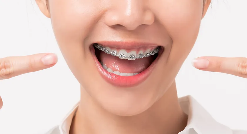 Nahaufnahme eines lächelnden Gesichts mit fester Zahnspange.